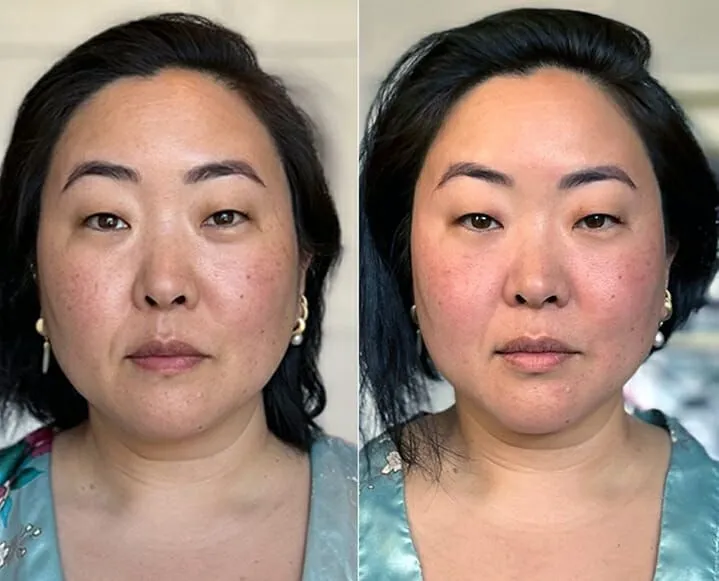 Microneedling Results